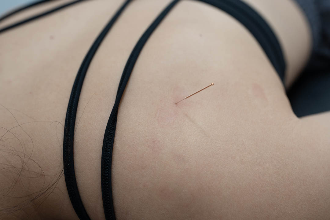 Registered Acupuncture